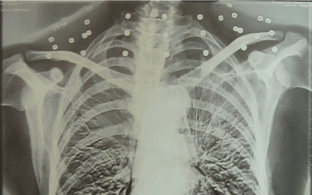 皇冠信用怎么弄
_“老先生皇冠信用怎么弄
,您把项链取下来再做CT”“你看是不是弹片”