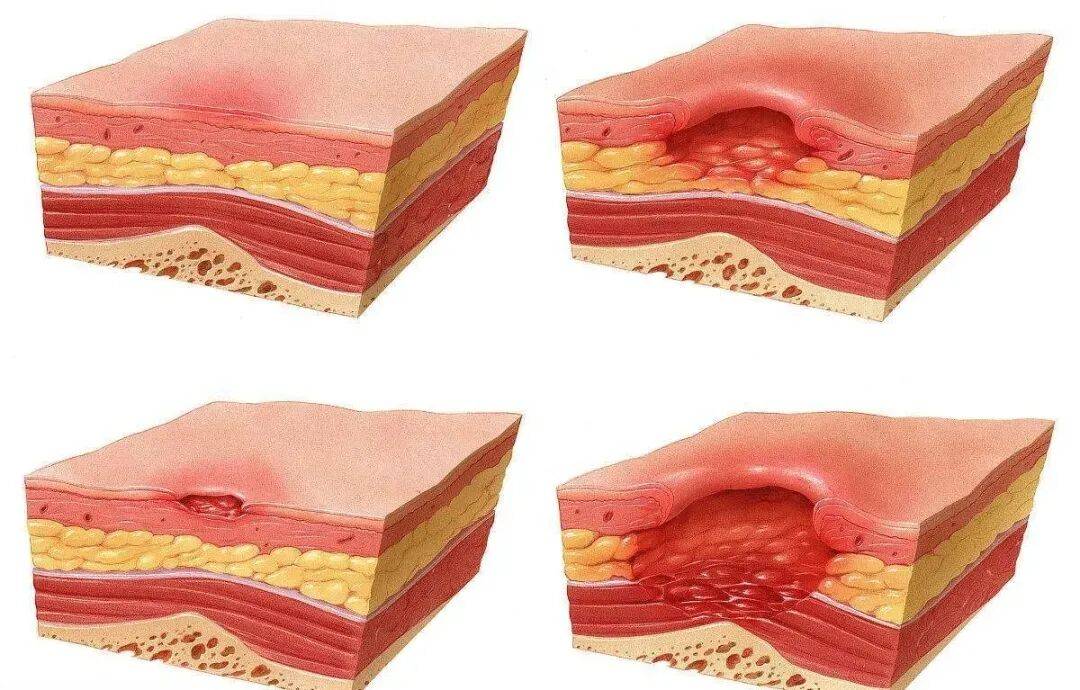 皇冠信用网代理_一觉醒来皇冠信用网代理,21岁女生的屁股惨不忍睹!严重或危及生命